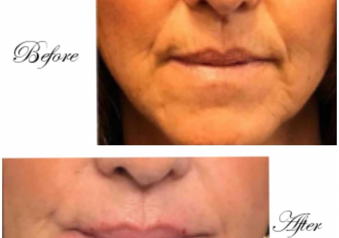 Nasal Fold Line Fillers 1ml