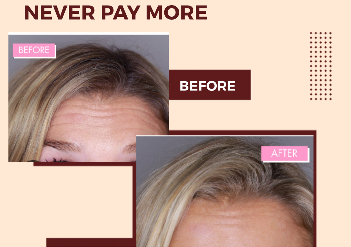 Botox  À La Carte Pricing