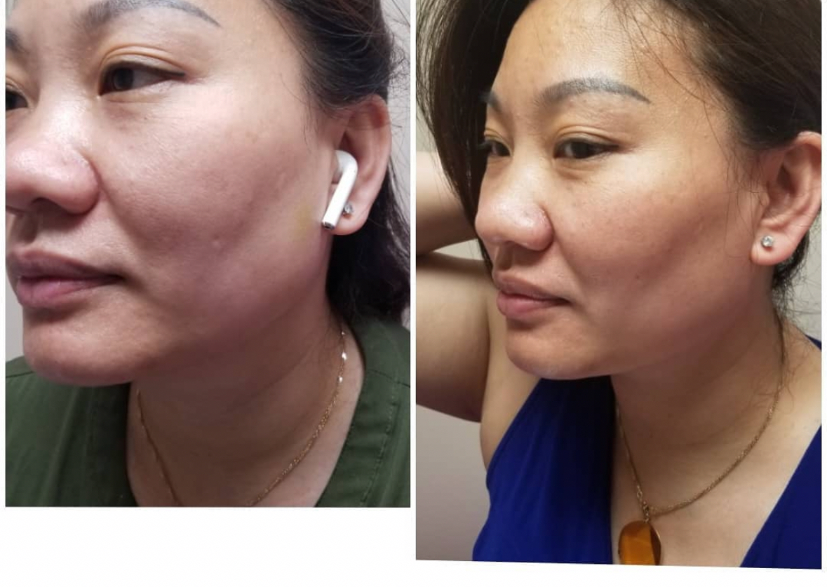 COG THREADS CHEEK LIFT