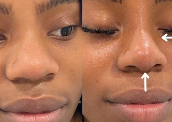 Reduction of Nose flare