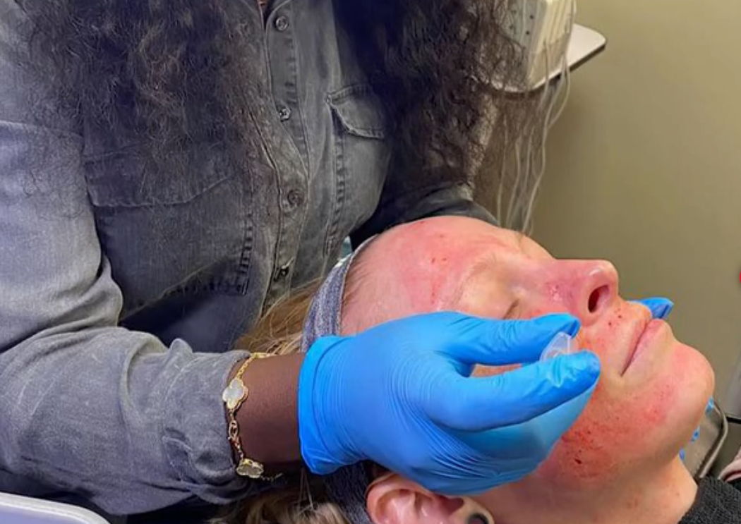 Microneedling PRP, Platelet rich Plasma