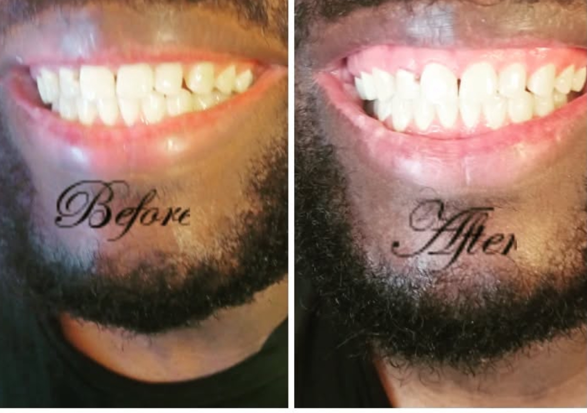 Teeth whitening 
