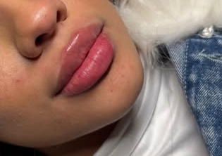 Basic Lip Enhancement  1ml