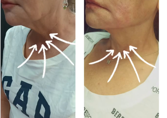 Nefertiti jawline, Jowls Botox lift