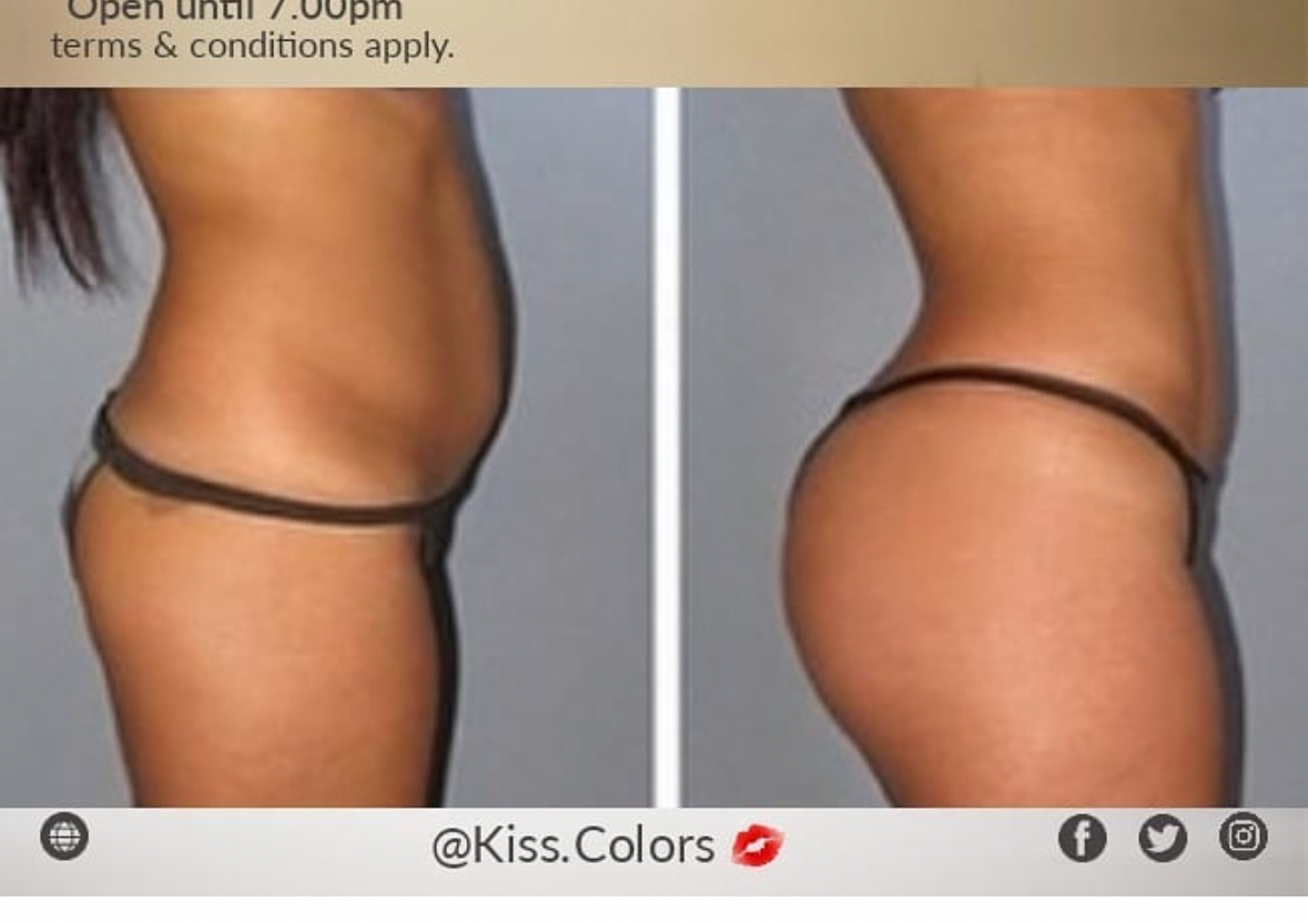Lipo Cavitation & Radiofrequency Skin Tightening Treatments