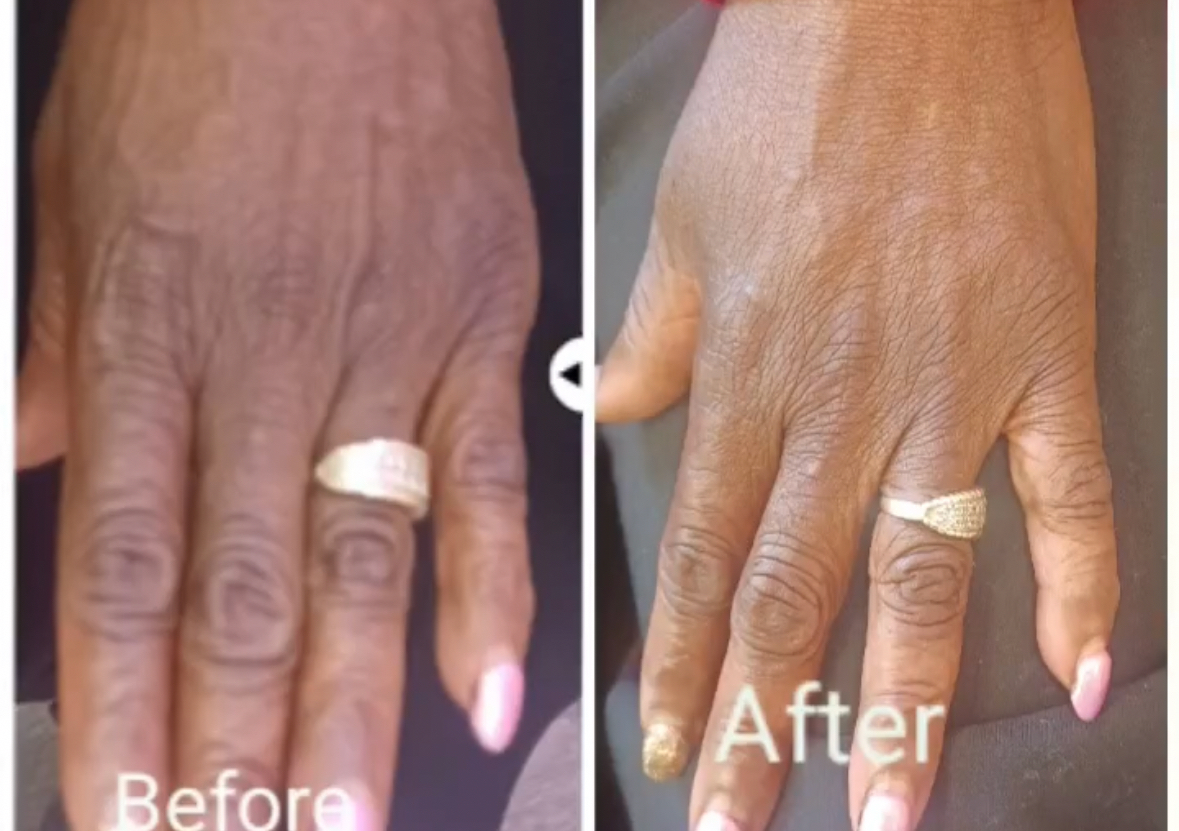 Radiesse Filler Per Syringe 1.5 Ml