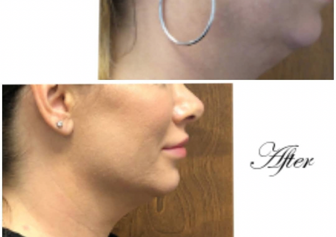 FAT  DISSOLVING INJECTIONS 