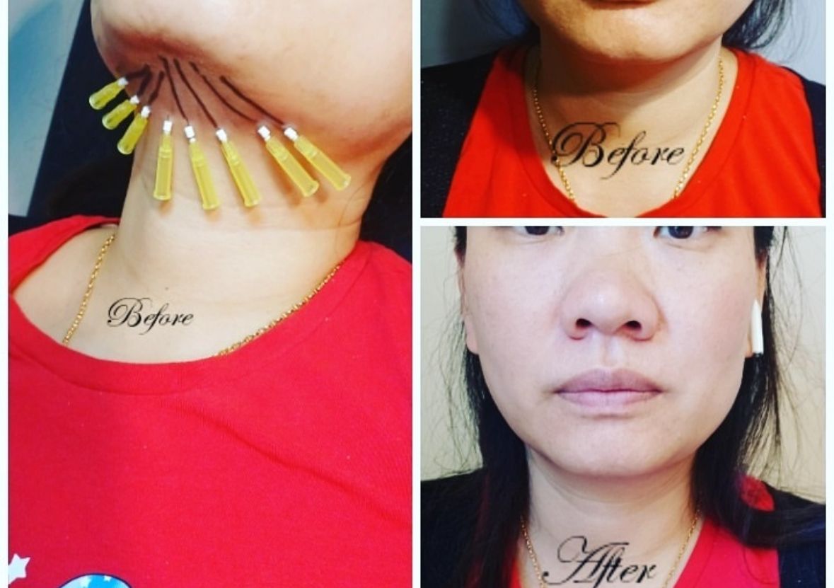 PDO Threads Mono Neck Tighten