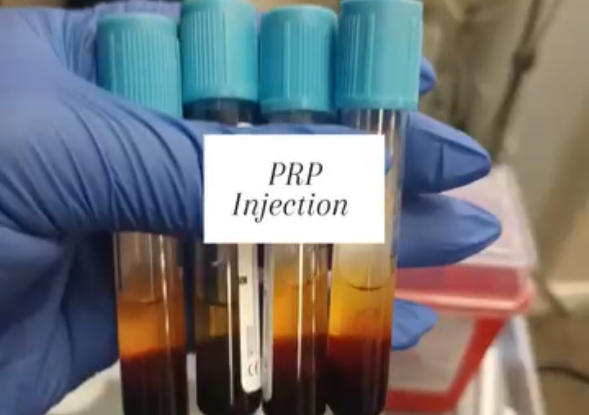 PRP UNDEREYE 
