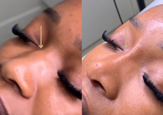 Liquid Nose Job Contour