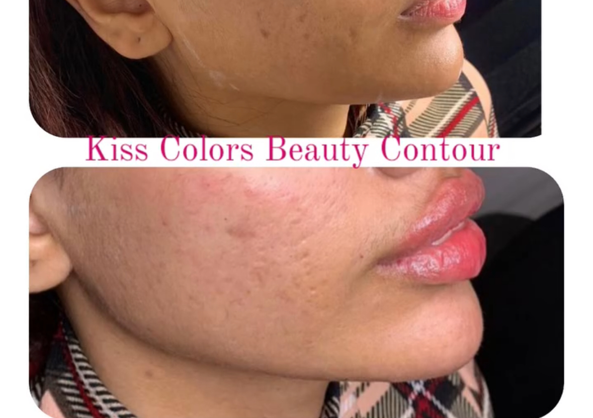 L Shape Jawline Revolax Filler Sub Q thick like Radiance Filler