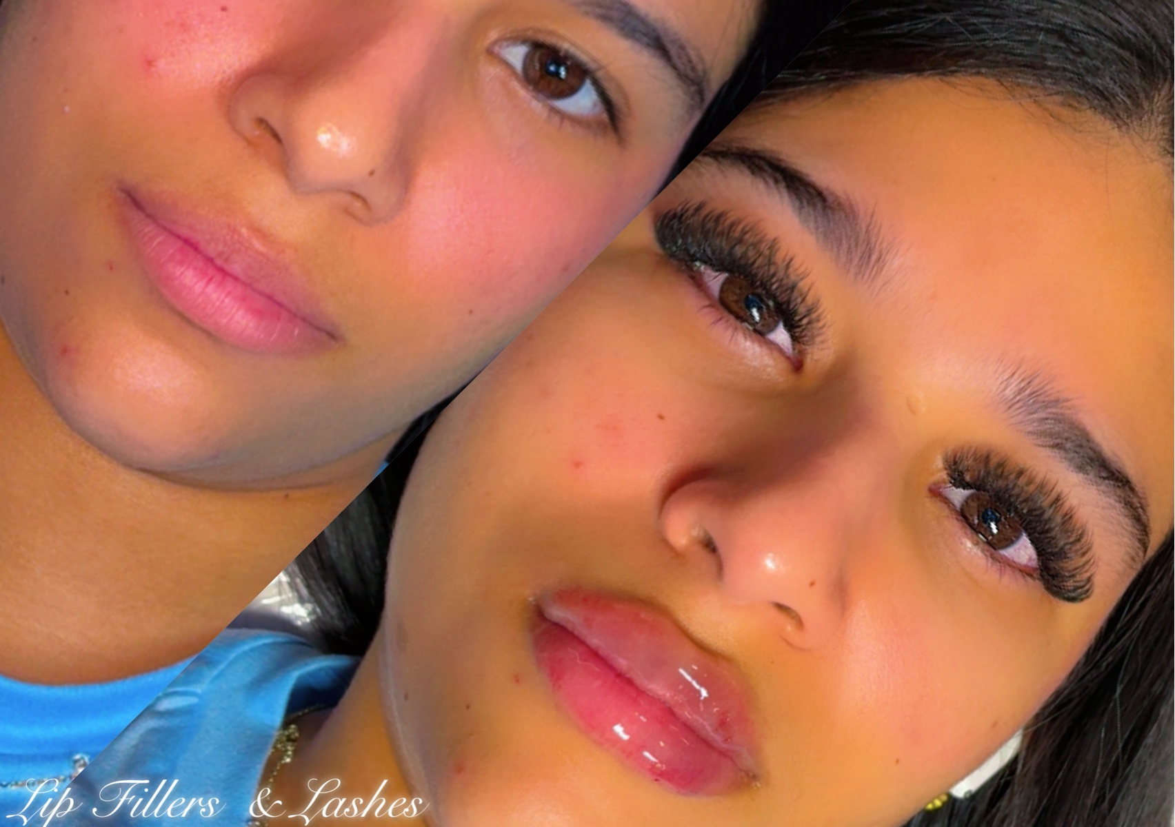 Lashes+. Lip Fillers 1/2 ml.