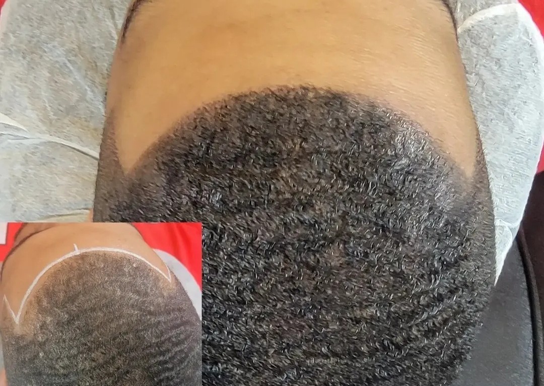 Scalp Micropigmentation (SMP) & Mesotherapy Hair Treatment Consultation (Non-surgical hairloss solutions) (2/2)