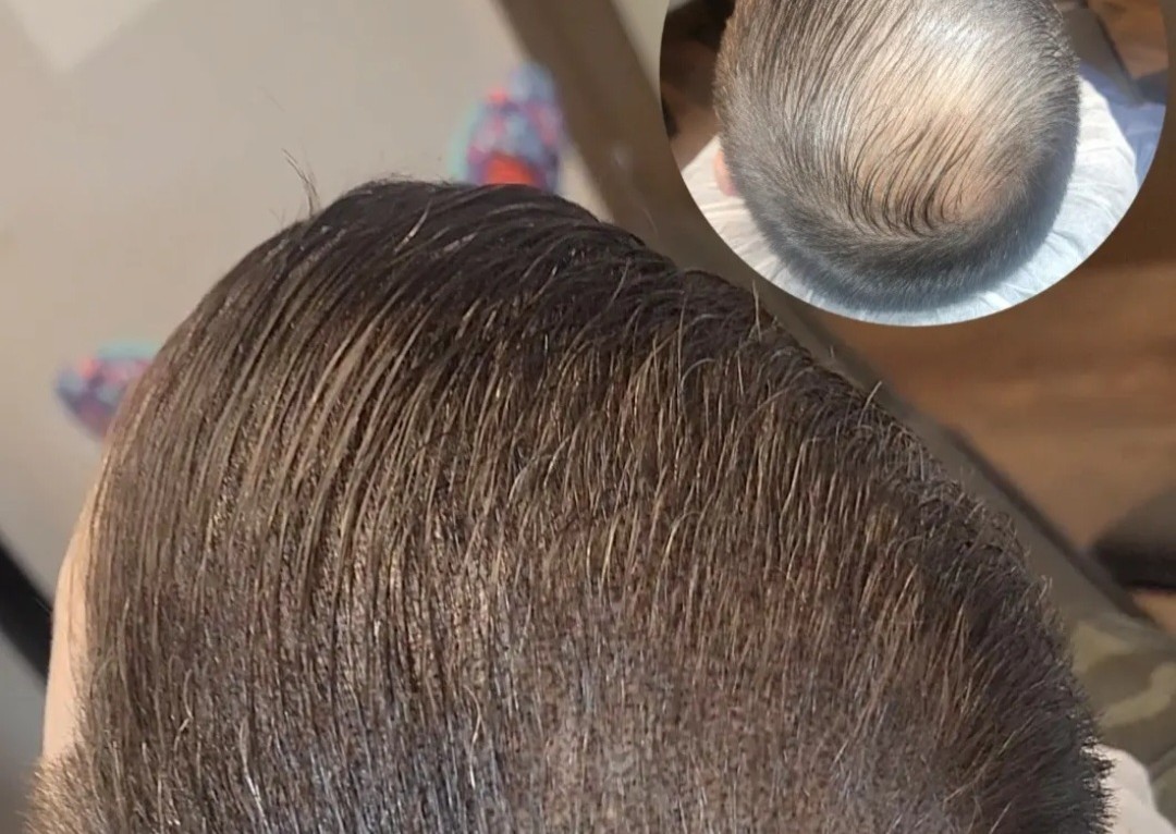 Scalp Micropigmentation (SMP) & Mesotherapy Hair Treatment Consultation (Non-surgical hairloss solutions) (1/2)