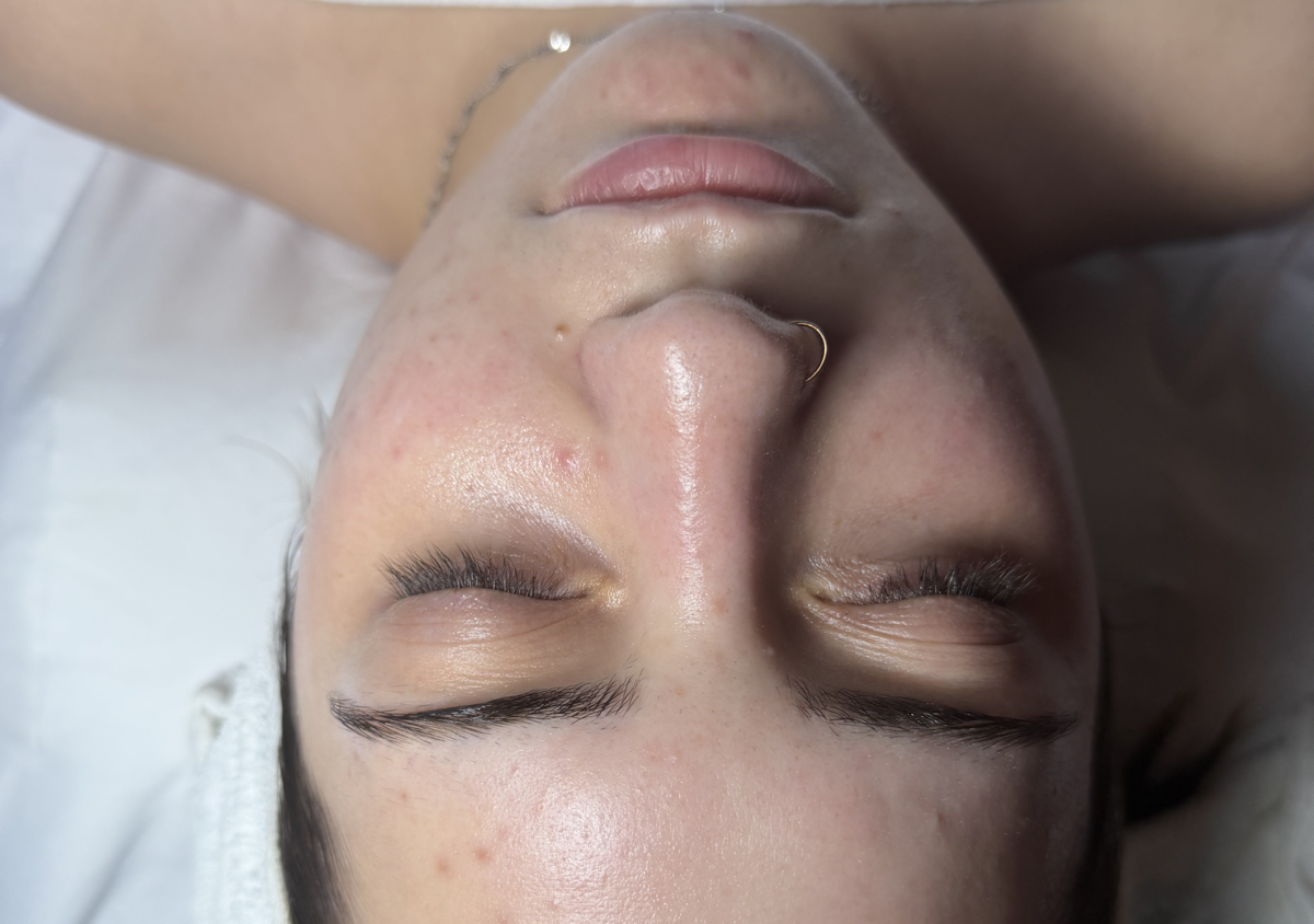 Acne Targeted