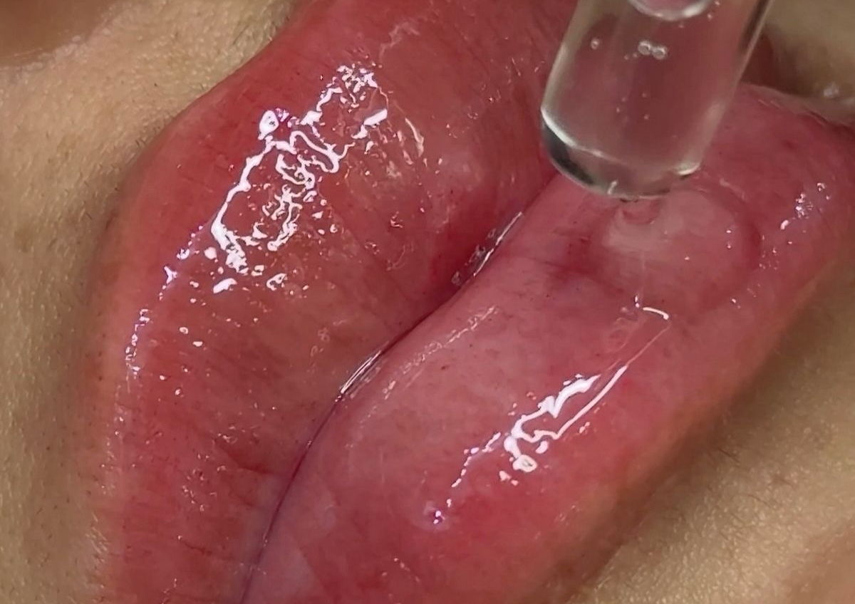 Hidratacion de labios con microneedling 