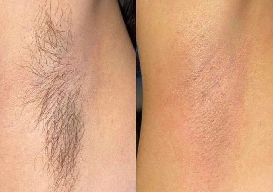 Epilación de axilas 