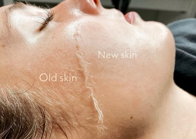 Dermaplaning