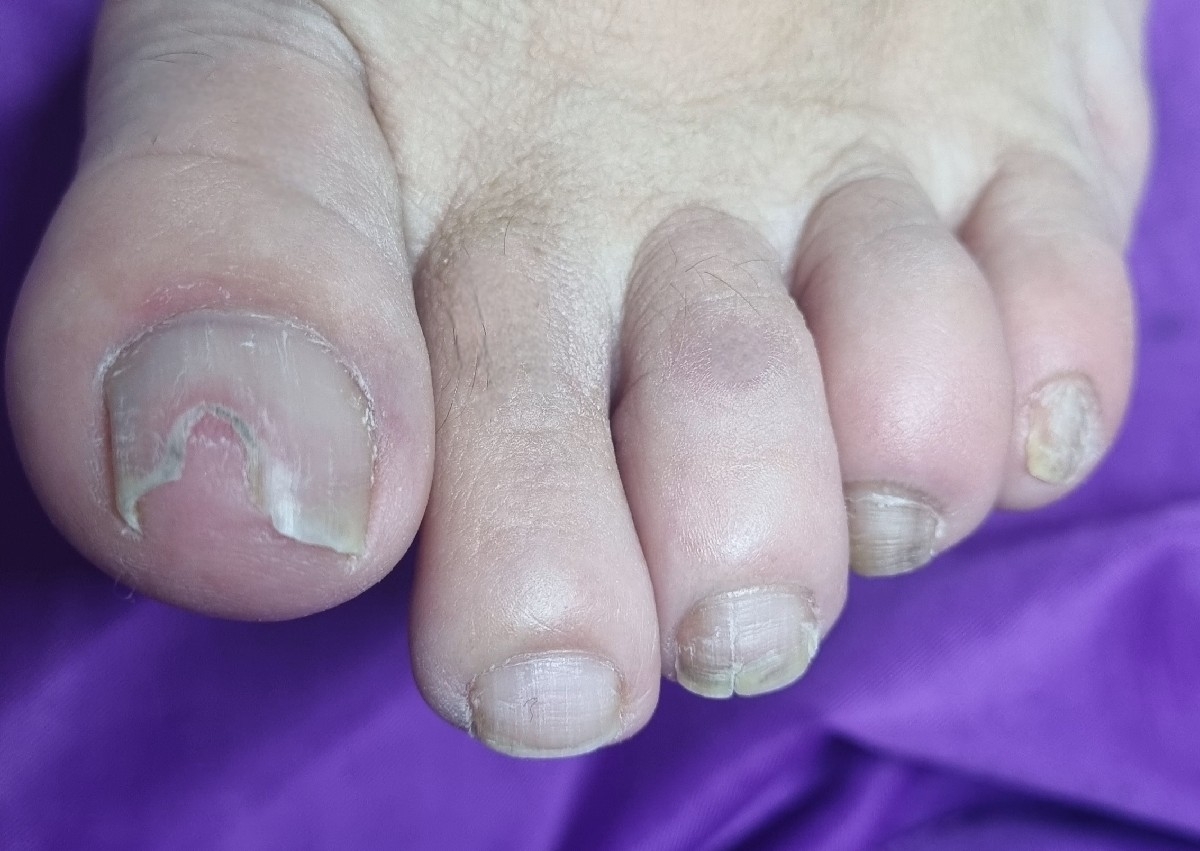 Fußnagelrekonstruktion