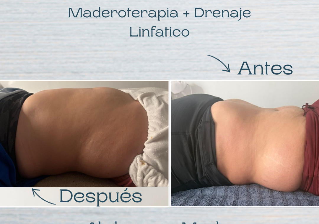 Maderoterapia Abdomen, Espalda y Muslo 
