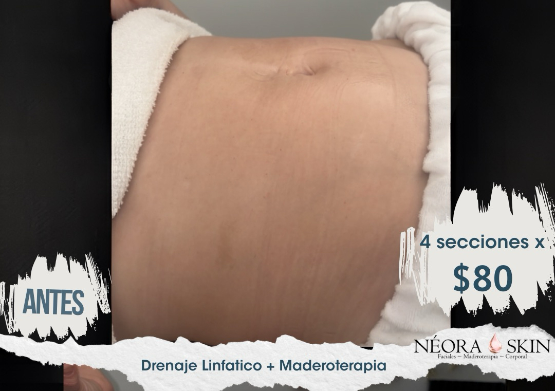 Maderoterapia Abdomen Paquete 