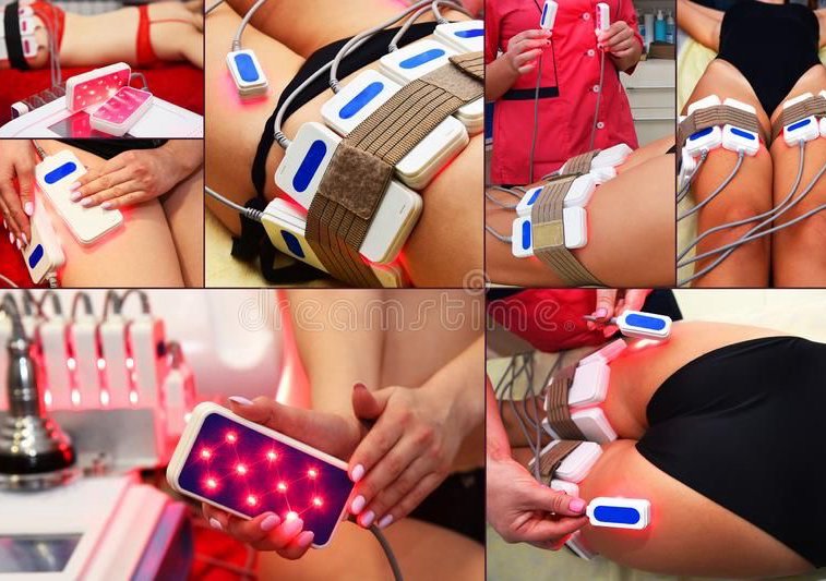 Lipo Laser Treatment