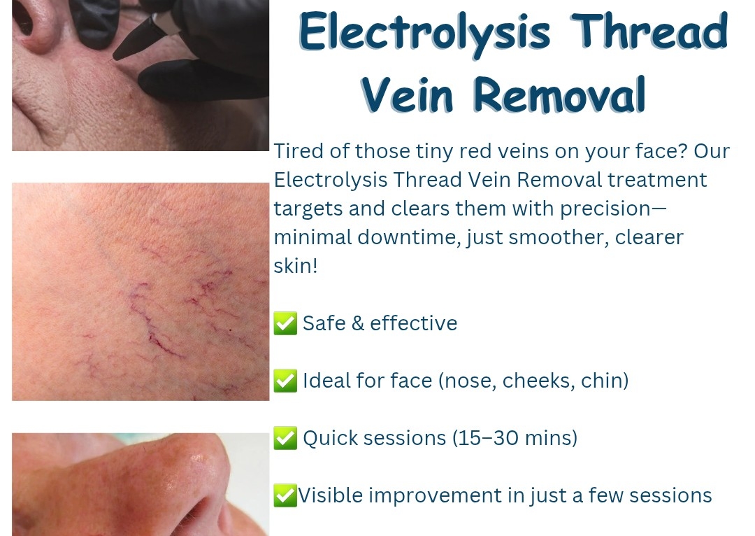 Electrolysis Thread Vein Removal