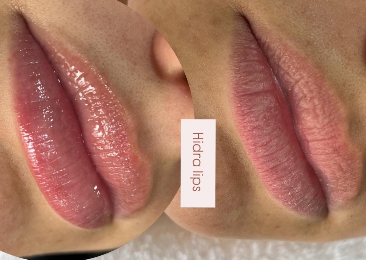 HidraLips 💋
