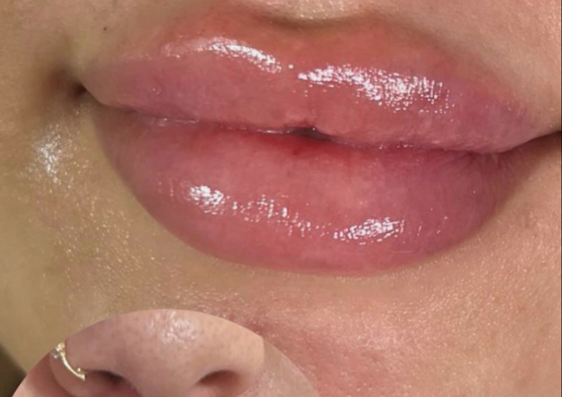 Amento de labios 
