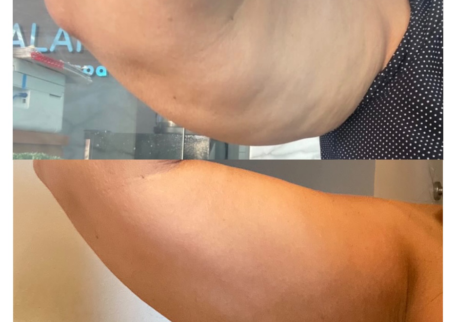 Hifu y rad fracc brazos 