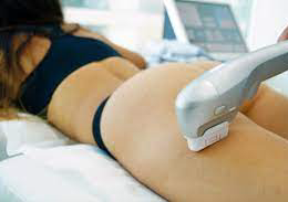 Hifu muslos completos