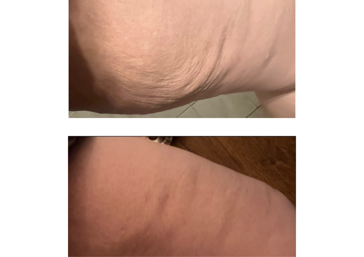 Hifu rad fracc entre piernas 