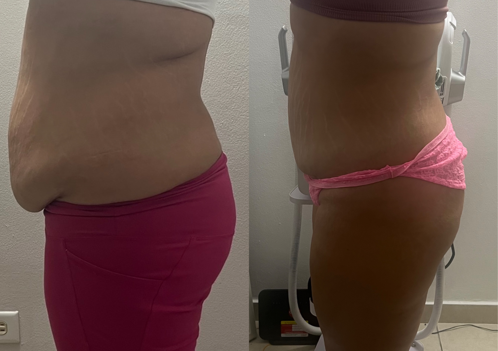 Hifu y rad fracc abdomen 