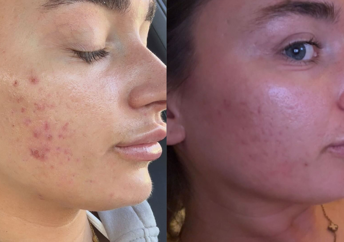 Acne skin reset course