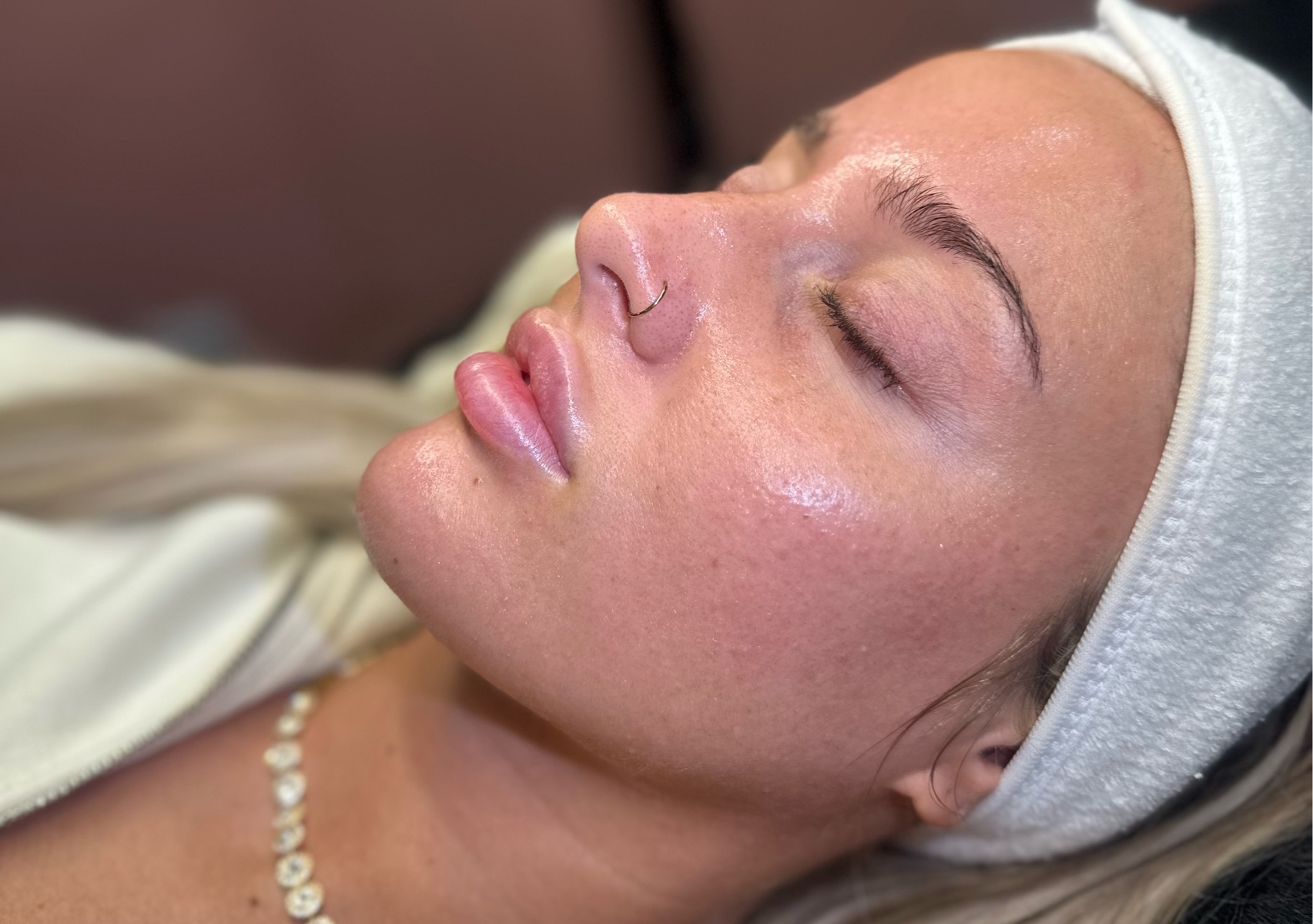 CHEMICAL PEEL 🧪