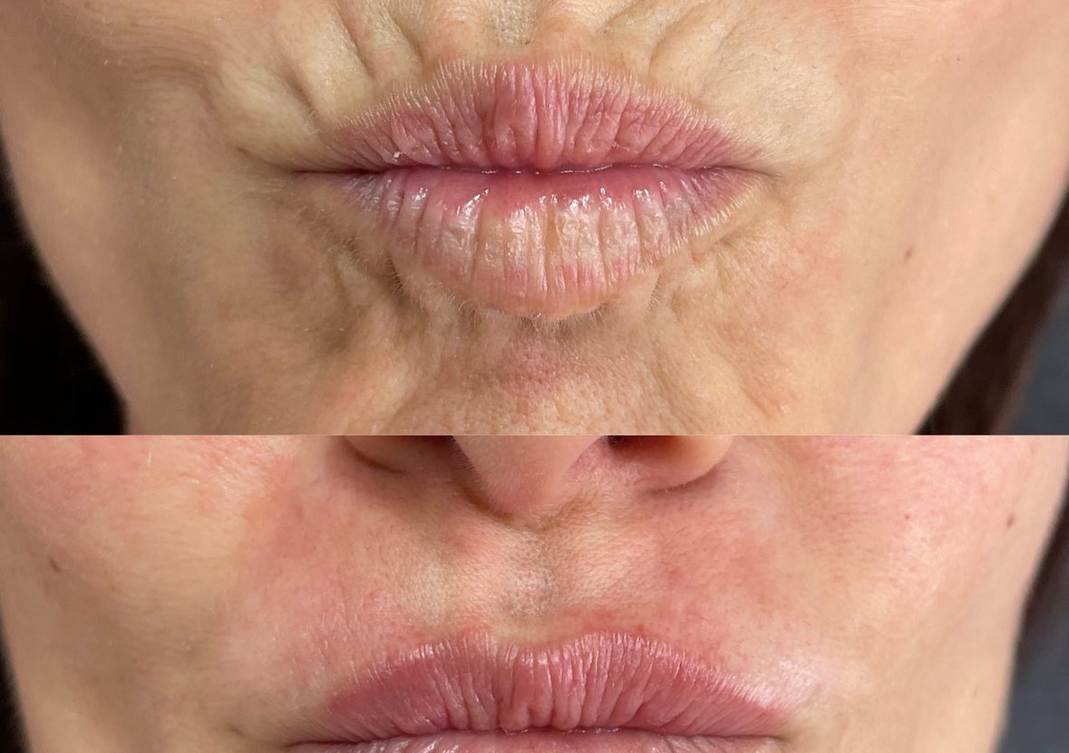 Perioral/Smokers Lines 0.5ml