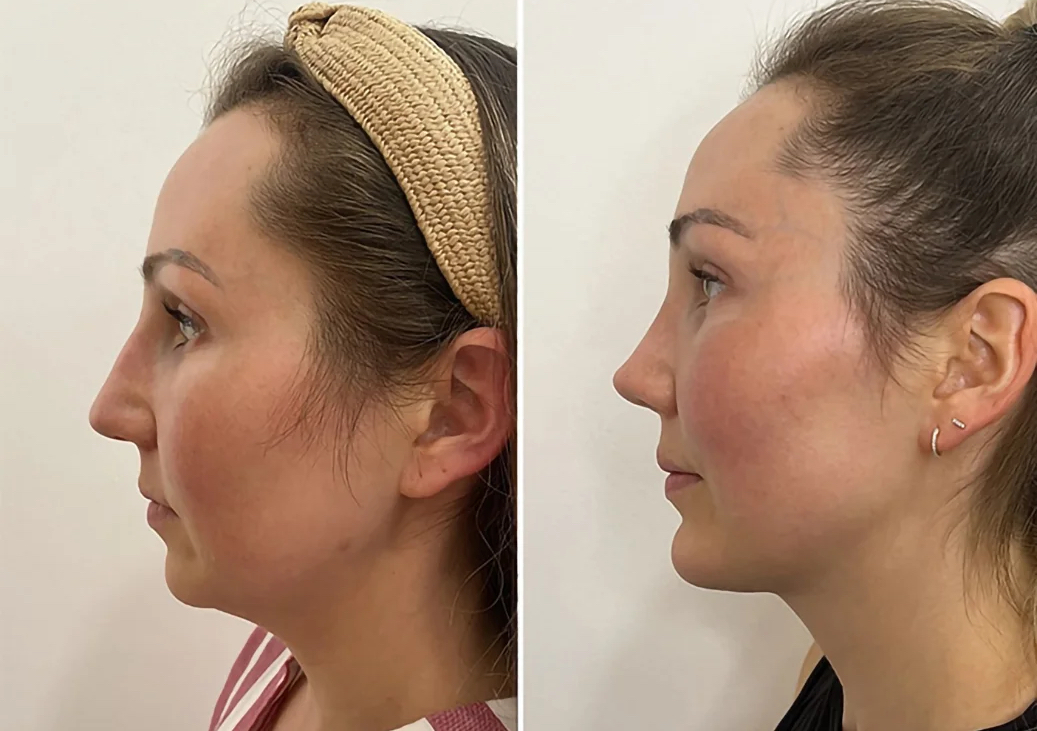 Chin Augmentation 3ml