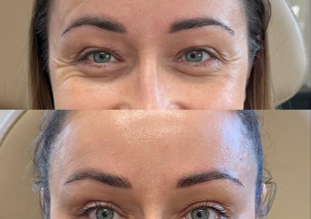Brow Lift 