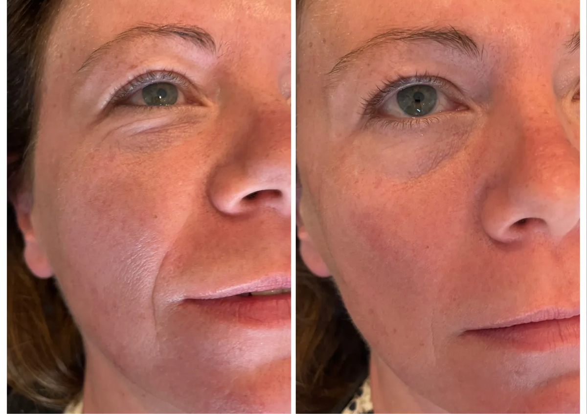 Nasal labial Folds 1ml