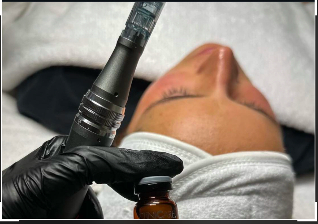 Microneedling - Refresh & Repair