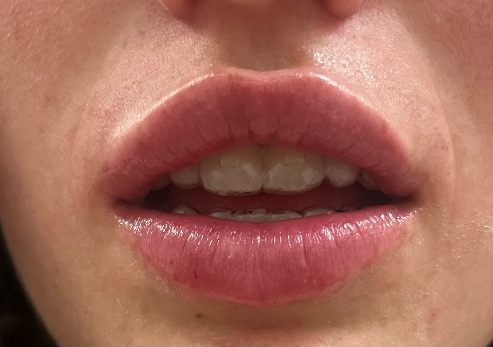 Lip Enhancement 0.5ml