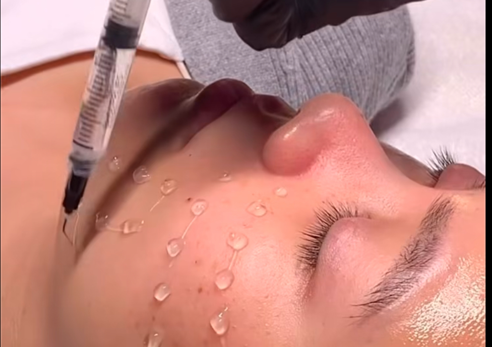 Microneedling & Dermaplaning