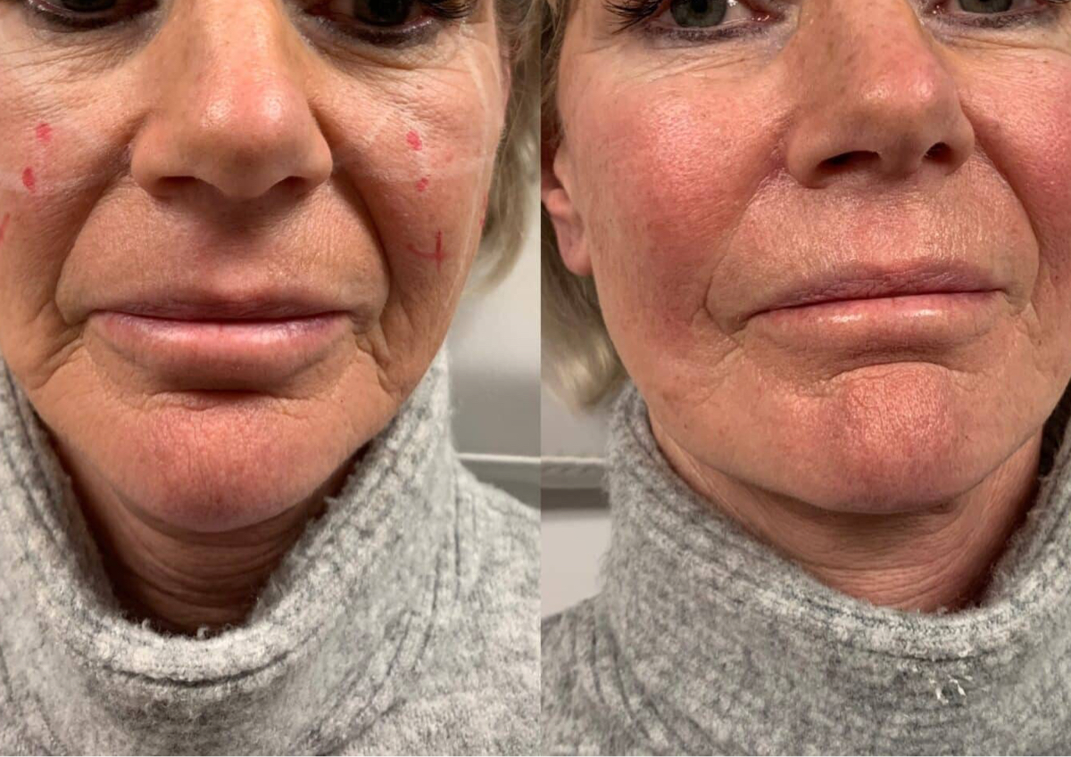 Marionette Lines 1ml