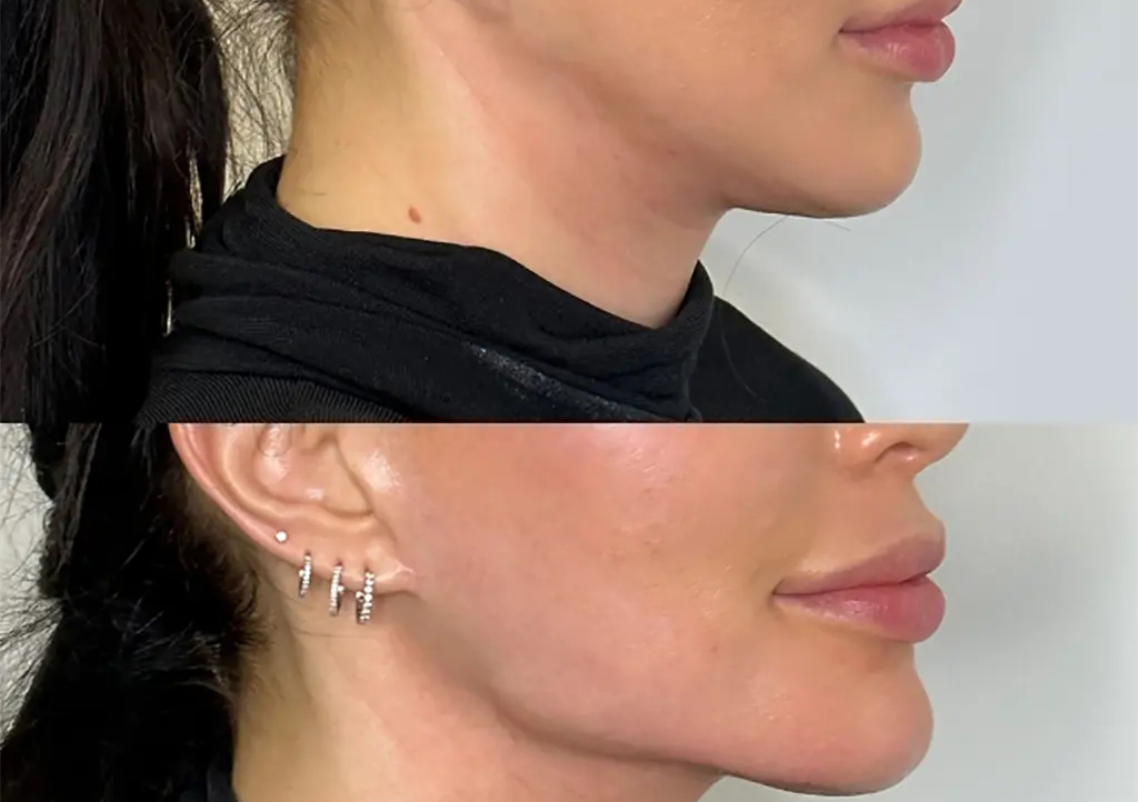 Jawline Augmentation 2ml