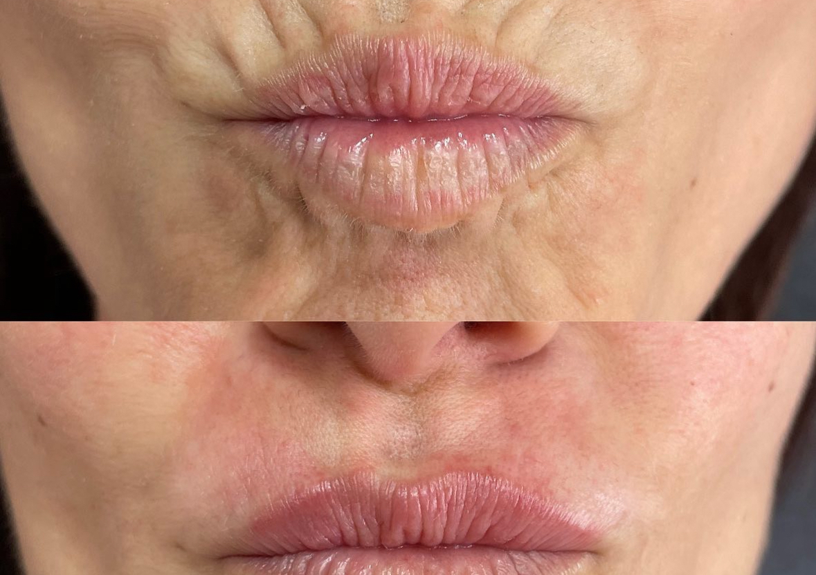 Perioral/Smokers Lines 1ml