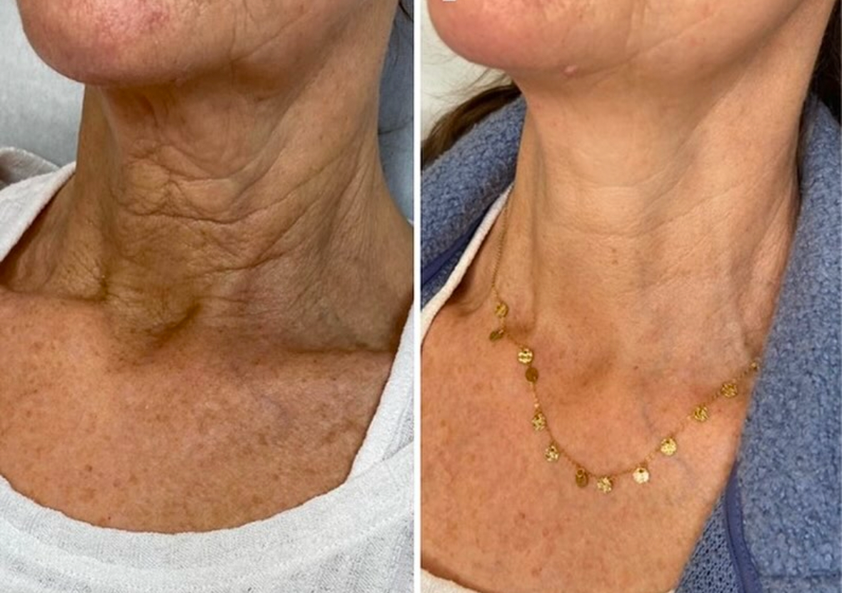 Skin Booster & Microneedling package