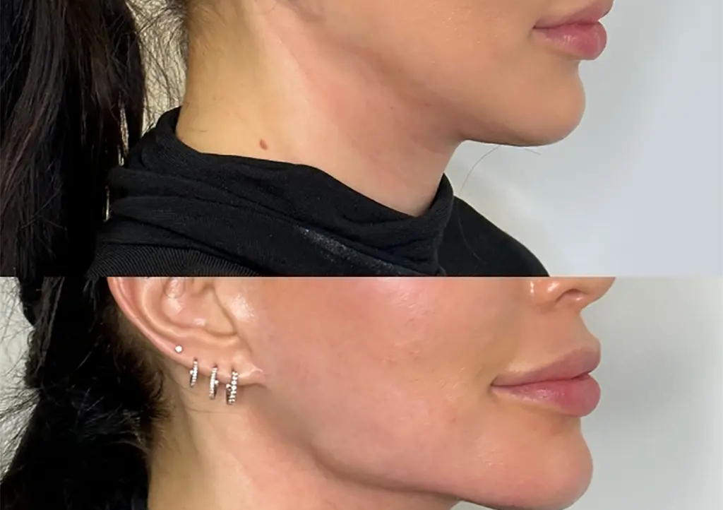 Jawline Augmentation 3ml