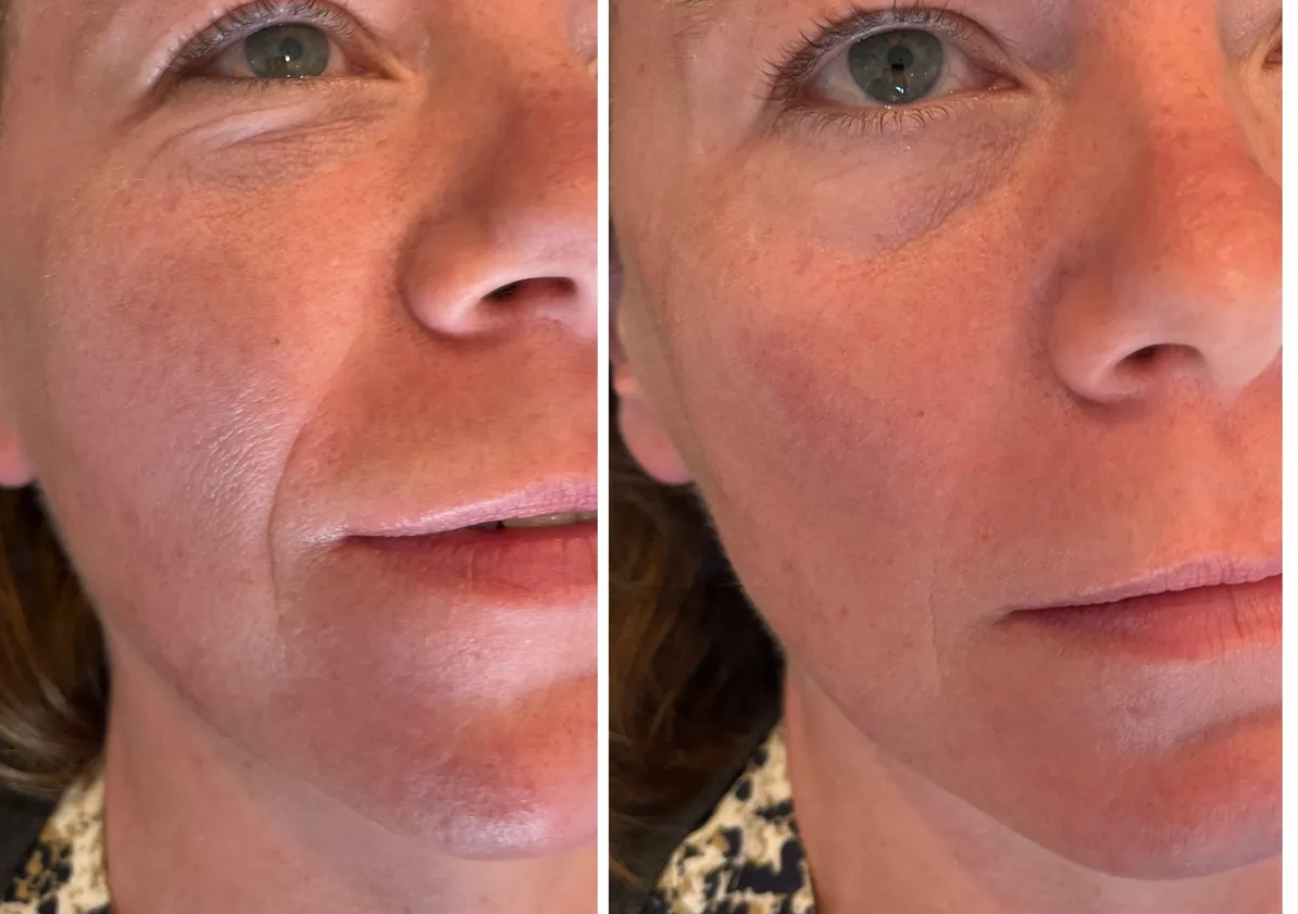 Nasal Labial Folds  2ml