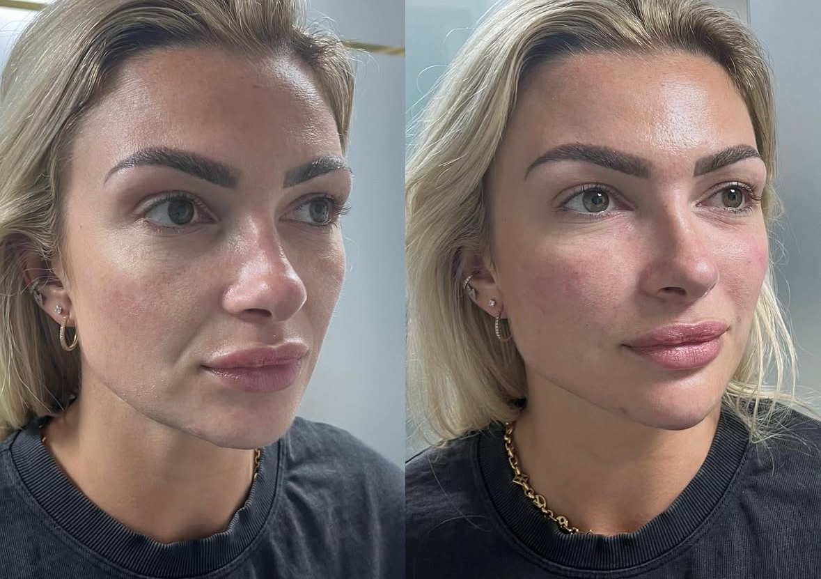 Cheek Augmentation 3ml