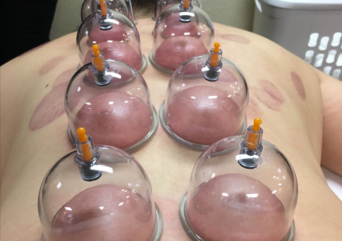 Cupping massage
